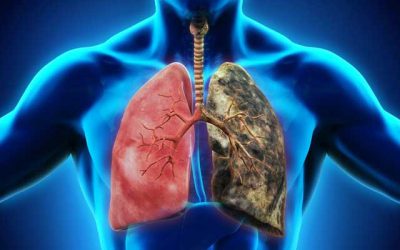 Lung Cancer - A Detailed Analysis and Treatment Options