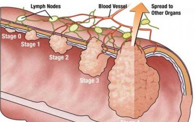 Causes, symptoms and treatment of Vulvar Carcinoma