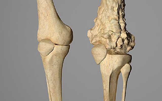 Osteosarcoma- Symptoms, Causes, Diagnosis, Treatment