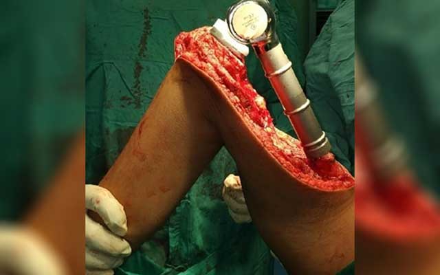Bone Cancer - Symptoms, Causes, Diagnosis And Treatment