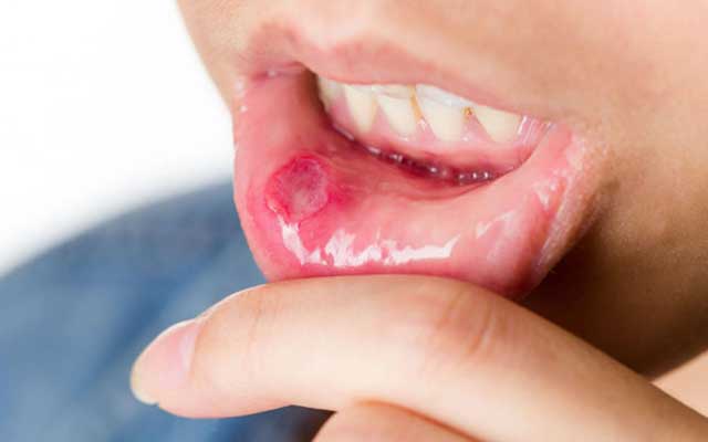 Oral Mucositis Causes, Impact and treatment.