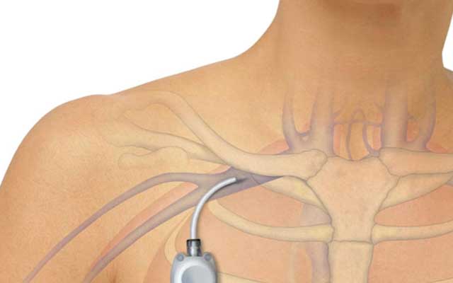 ChemoPort- Procedure of inserting it and advantages