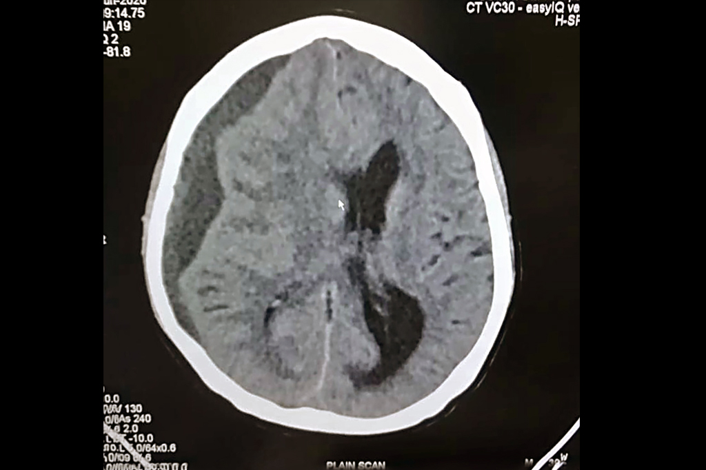 A silent Danger!! Chronic subdural hematoma!!