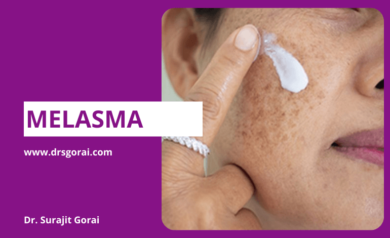Melasma Treatment