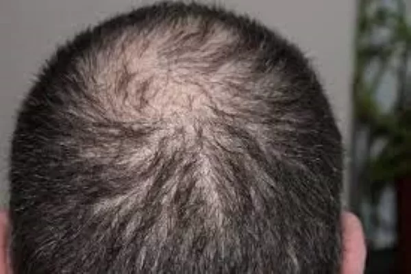 Benefits Of Hair Transplant Beyond Improved Appearance!