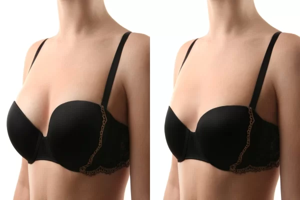 Breast Augmentation In Kolkata- For A Confident You!