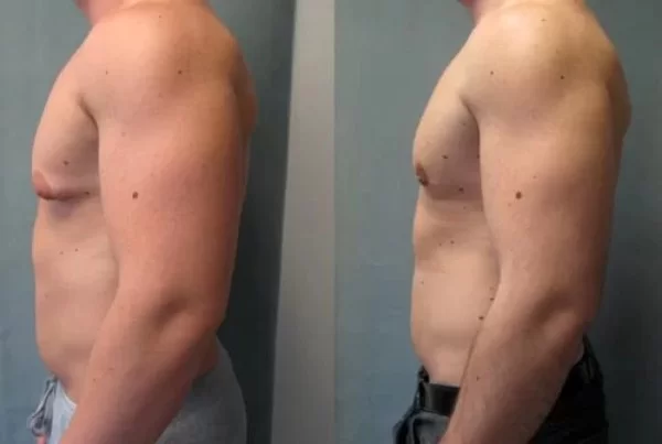 A Few Known Gynecomastia Facts