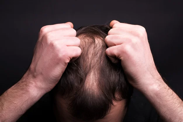 Hair Transplant Surgery in Kolkata