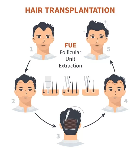 Everything To Know About FUE Hair Transplant in Kolkata