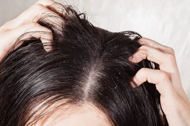 How To Get Rid Of Dry Scalp In Winter