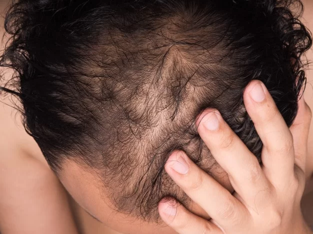 Follicular Unit Extraction: How Does It Work