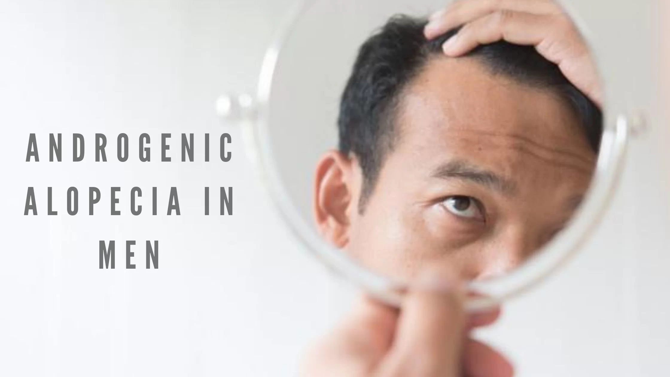 Androgenic Alopecia in Men: Symptoms, Causes, Treatment