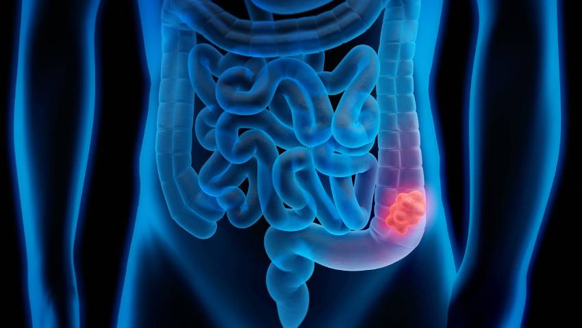 Understanding Colorectal Cancer: Risk Factors and Prevention Strategies